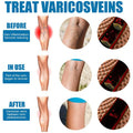 South Moon Varicose Veins Treatment Spray – 30ml Advanced Formula for Spider Veins, Leg Pain & Swelling Relief | Natural Herbal Spray for Better Circulation