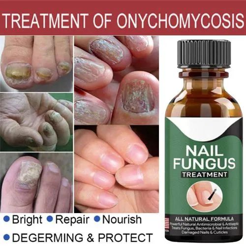 Fast Nail Fungal Treatments Nail Repair Essences Serum Care Treatments Foot Nail Fungus Removal Gel 2941129